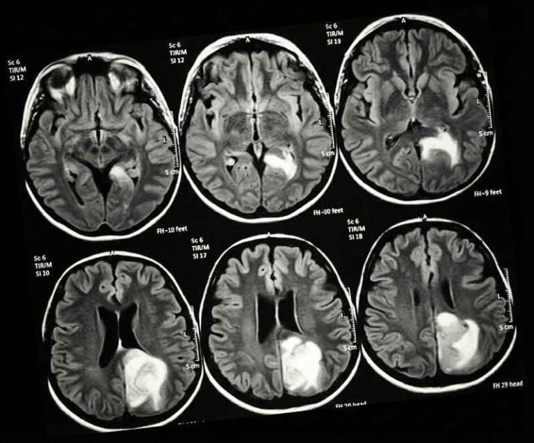 Advanced Glioma Neurosurgery​
