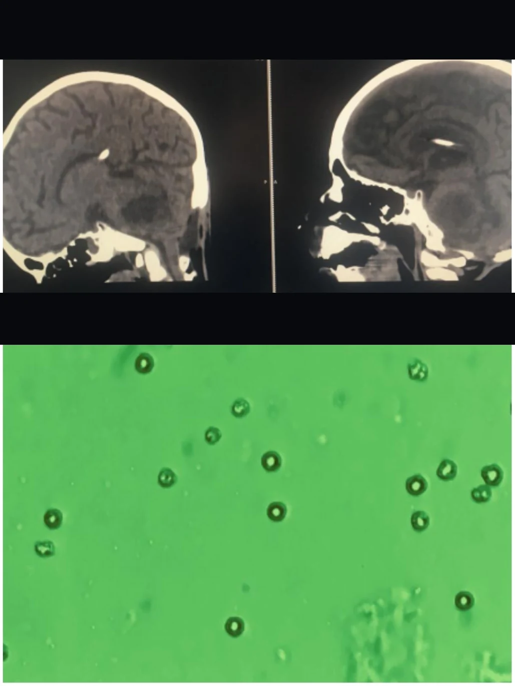 Figure 1 from the 2019 publication: two sagittal cranial CT scans of the pontine tumor one week apart, and light microscopy of tumor-immunized autologous NK cells